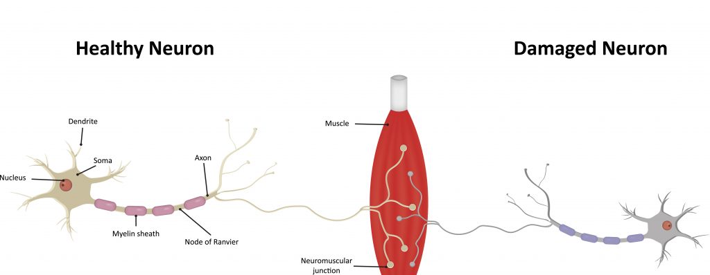 motor-neurone-disease-oxford-medical-education